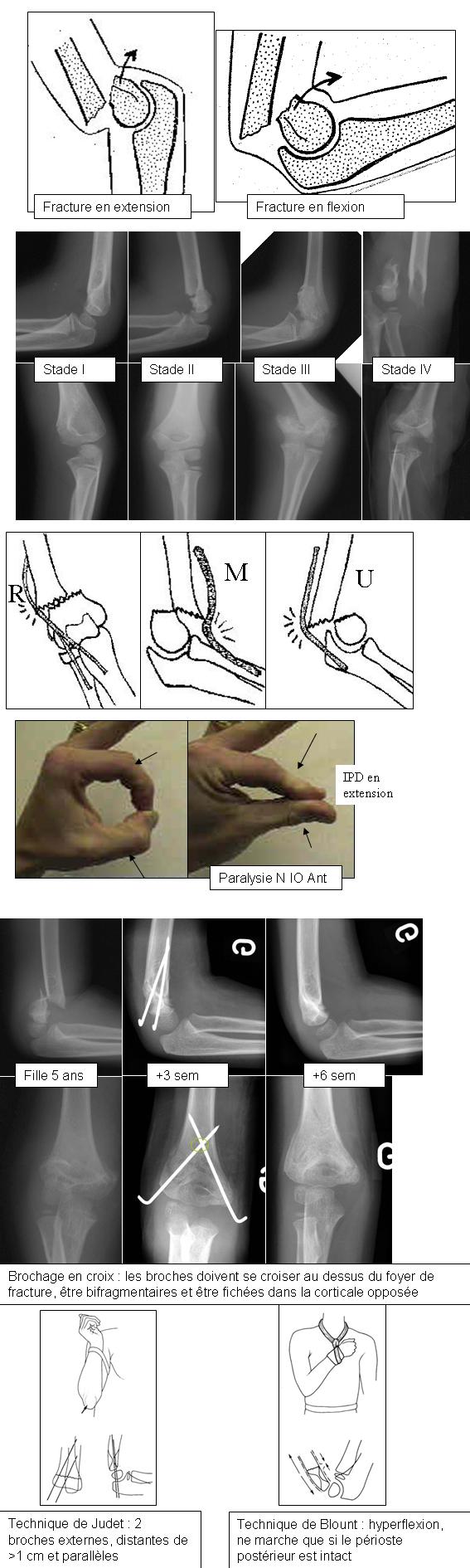 dureri articulare la genunchi ce este recuperare după traumatismul meniscului articulației genunchiului