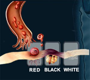 endometriose-01