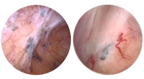 endometriose