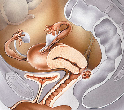 endometriose