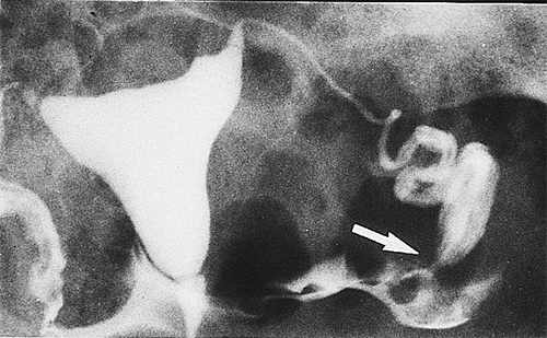 pathologie-trompe-uterine