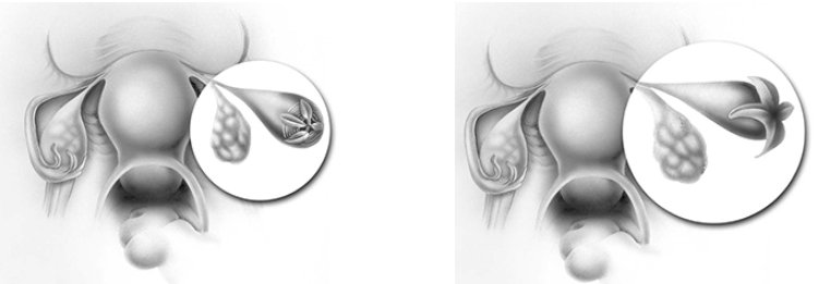 pathologie-trompe-uterine-2