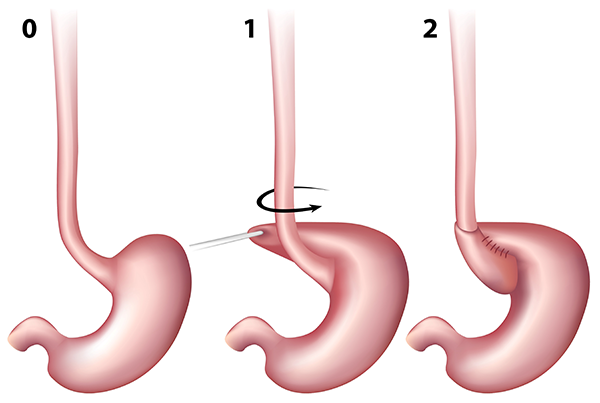 schema-nissen-fundoplicature