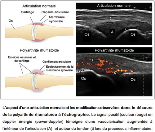 Rhumatologie - Polyarthrite rhumatoïde