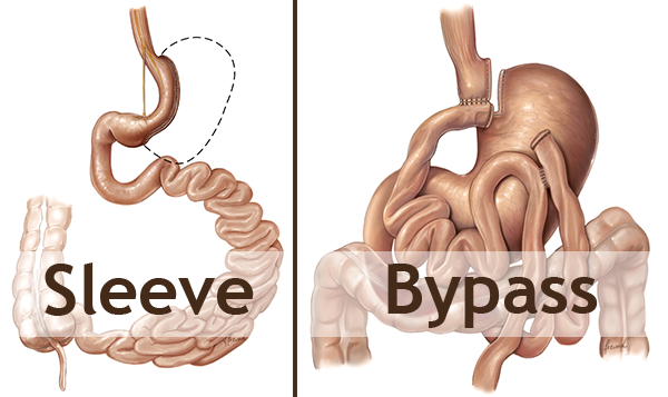 article-2-b-2-types-chirurgie-bariatrique