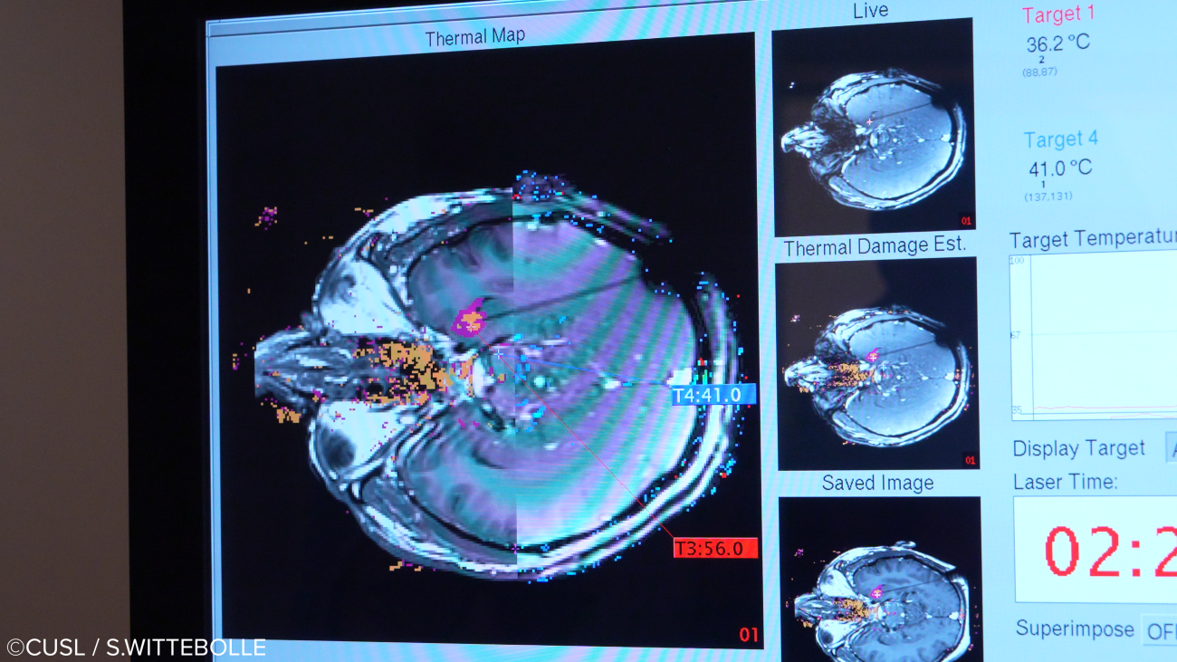Neurochirurgie - opération d'épilepsie réfractaire