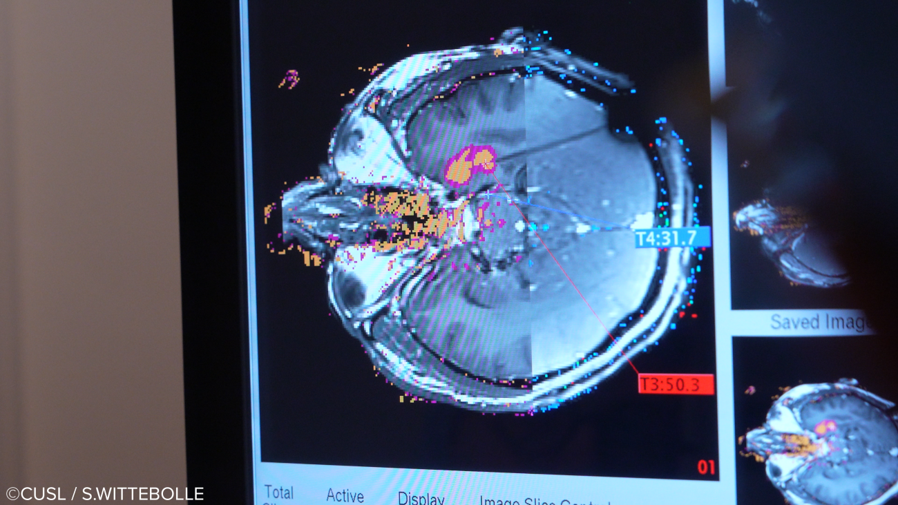 Neurochirurgie - opération d'épilepsie réfractaire