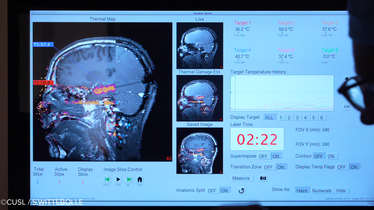 Neurochirurgie - opération d'épilepsie réfractaire