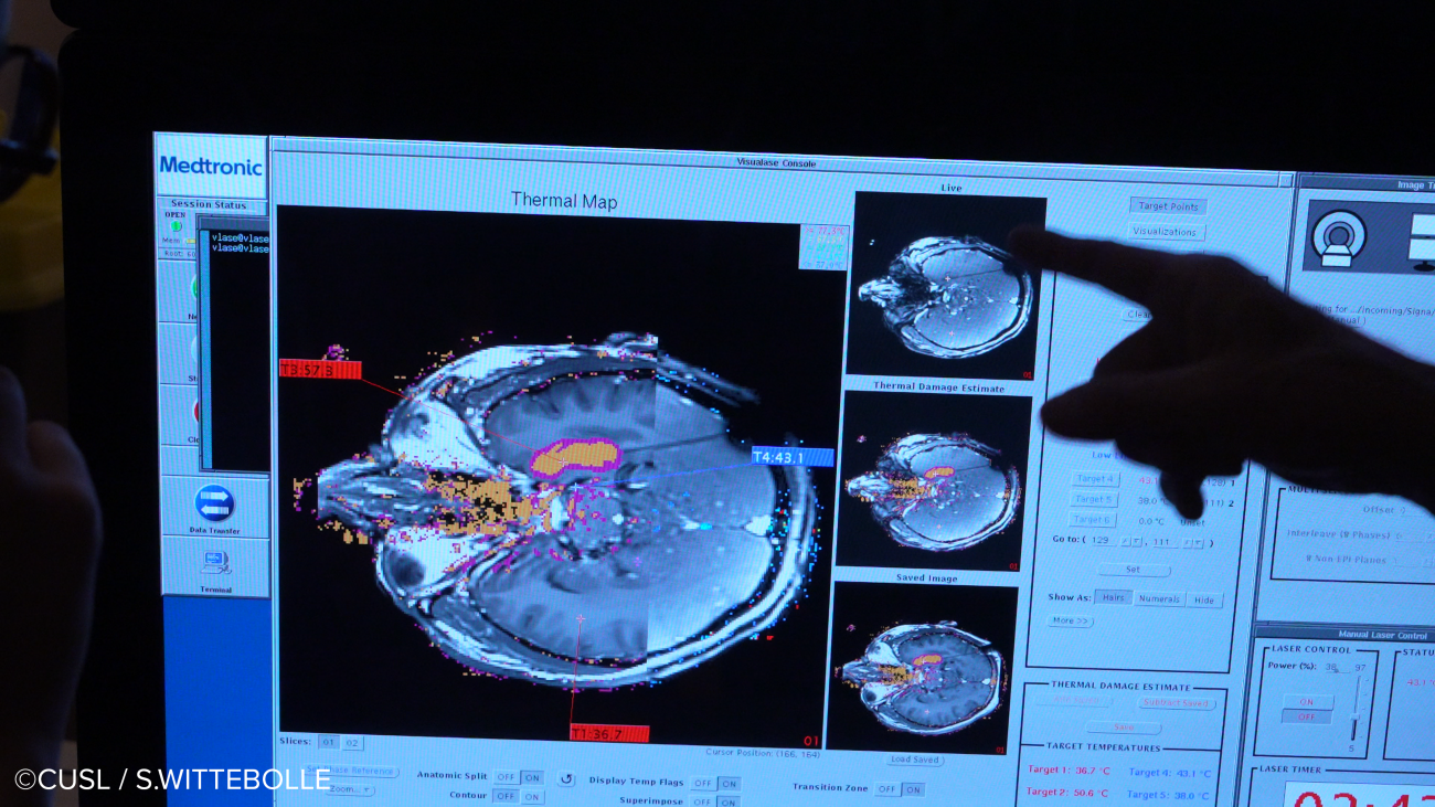 Neurochirurgie - opération d'épilepsie réfractaire
