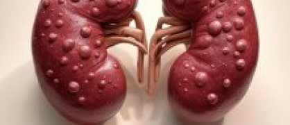 polykystode-renale
