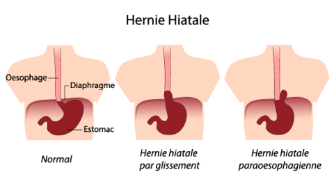 hernie-hiatale