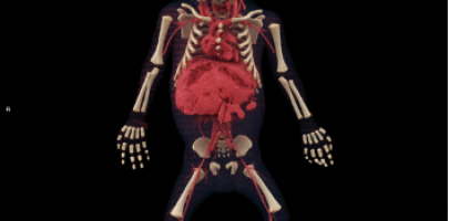 Angiographie post mortem